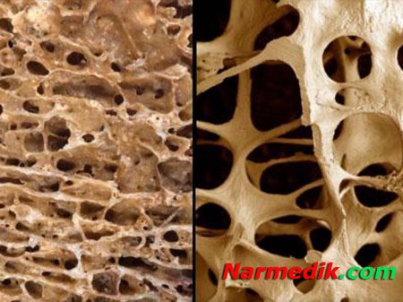 5 вещей, которые нужно знать об остеопорозе